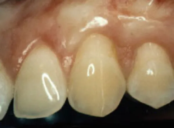 Gum grafting — after treatment