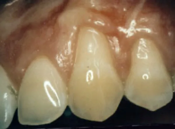 Gum grafting — before treatment